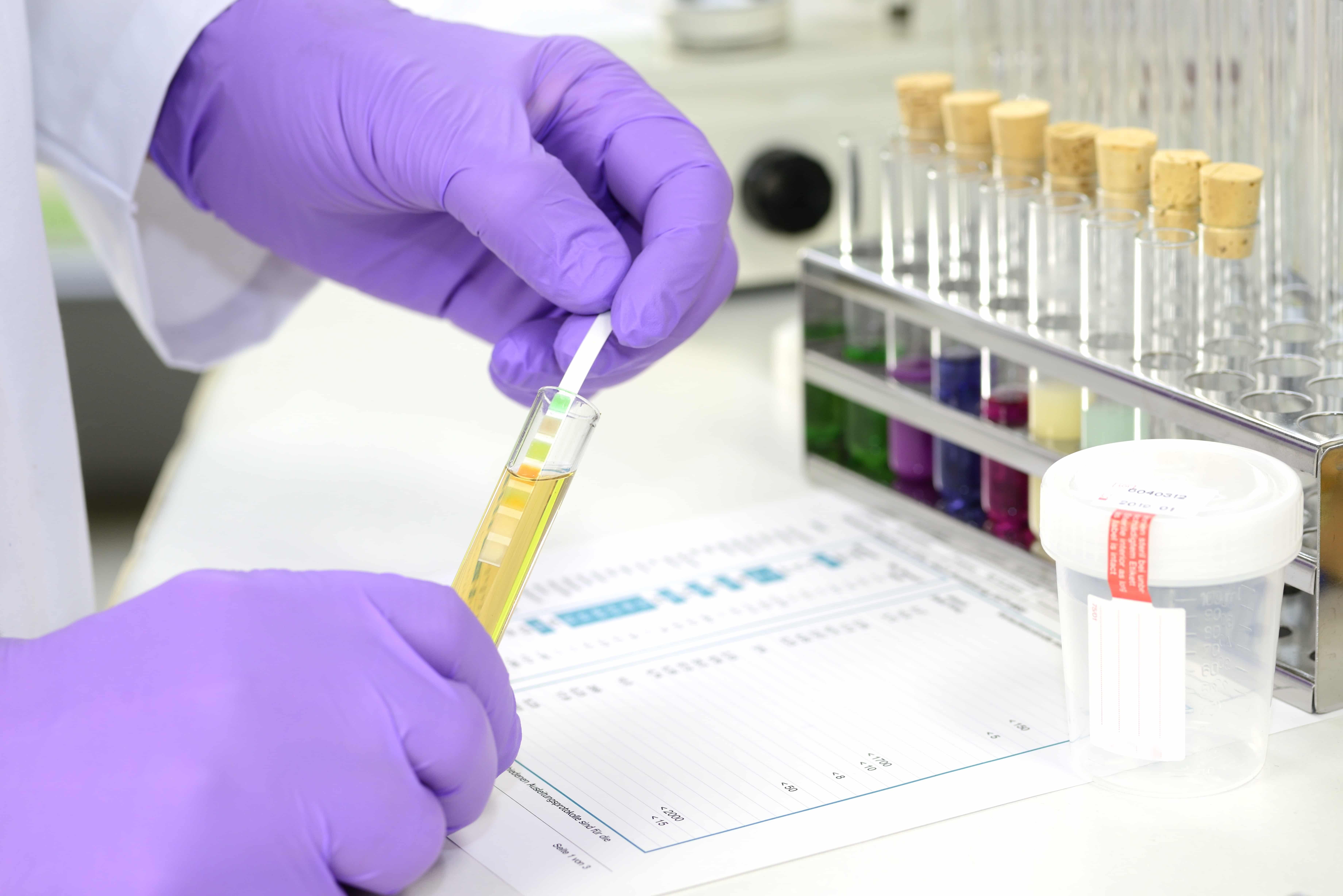 After test testing. Drug Testing. 17-Оксикортикостероидов в моче. Проба с красителем. Drug Screening.